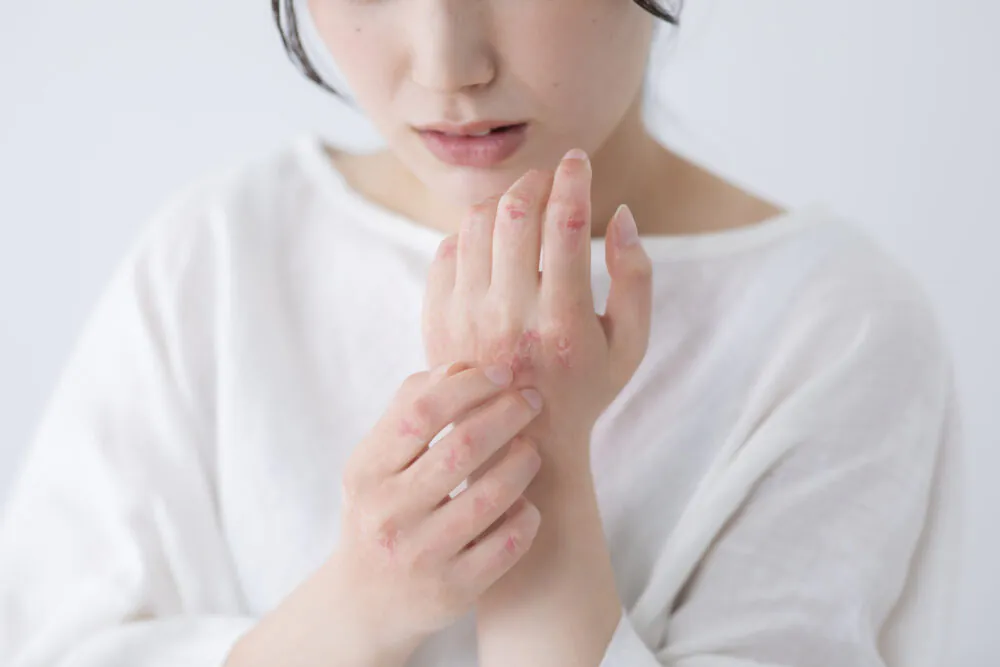 光線療法